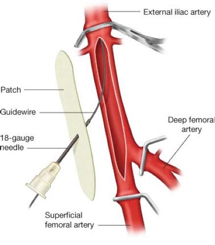 Femoral Peroneal Bypass