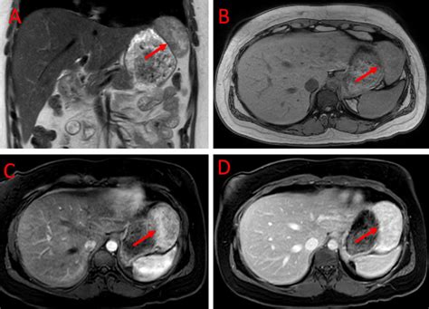 -MRI of the abdomen with and without contrast. (A) T2 coronal sequence... | Download Scientific ...