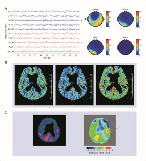 JLE Epileptic Disorders Isolated Aphasic Status Epilepticus CT