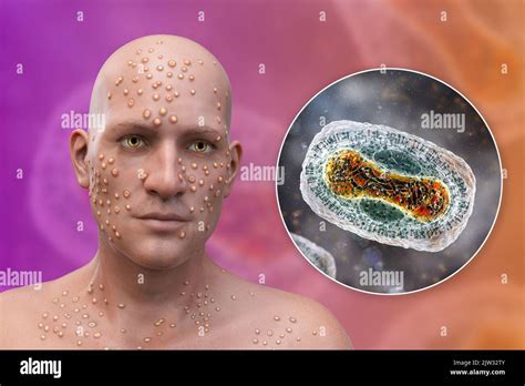 Tanapox Virus Hi Res Stock Photography And Images Alamy