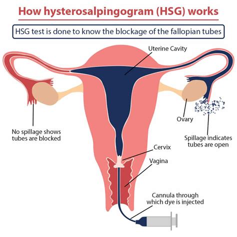 Hysterosalpingogram Hsg What You Need To Know About A Hsg