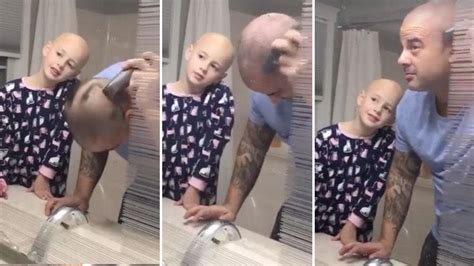 Dad Shaves His Head After Daughter With Alopecia Says She Doesnt Love