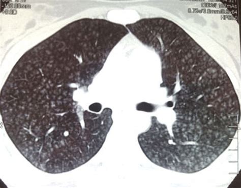 Diffuse Micronodular Pattern With Well Defi Ned Centrilobular Nodules