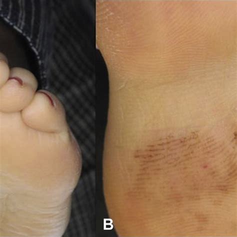 Pdf Acral Lentiginous Melanoma In Situ With A Characteristically