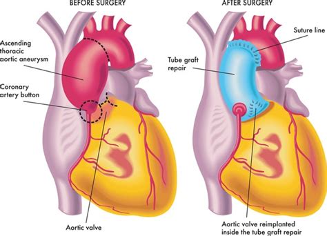 54 Ascending Aortic Aneurysm Stock Vectors and Vector Art | Shutterstock