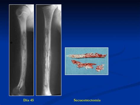 Tratamiento Osteomielitis Us