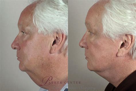 Facelift Before And After Photo Gallery Paramus Nj Parker Center For Plastic Surgery