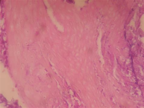 PILOMATRICOMA – Histopathology.guru