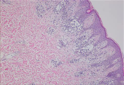 Annular Lichenoid Dermatitis Of Youth In A 15 Year Old Boy Topical