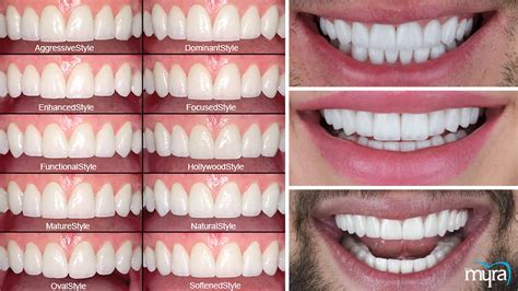 5 Side Effects Of Dental Veneer