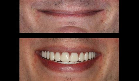 Upper And Lower Implant Overdentures Total Implants Male