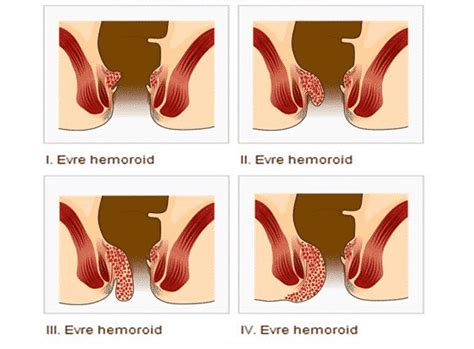 Hemoroid Ve D Hemoroid Nedir Ata Ehir Cerrahi