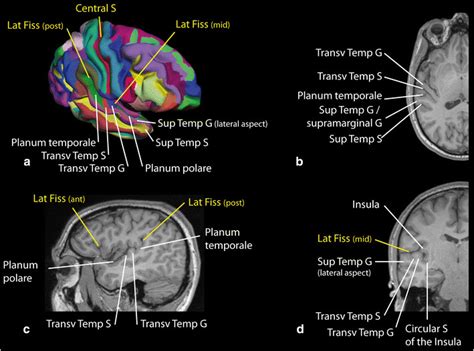 Identification Of The Main Sulci And Gyri Of The Dorsal Aspect Of The