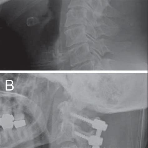 Lateral Pre A And 1 Year Postoperative B Cervical Spine Xrays Download Scientific Diagram