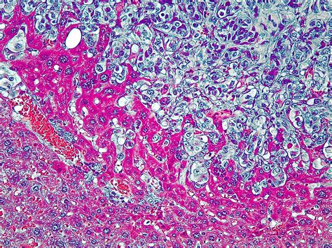 Liver Metastasis In Kaposi Sarcoma Mouse Model The Image S Flickr