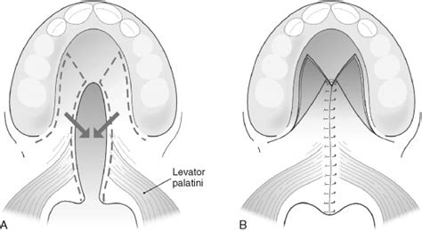 CLEFT PALATE REPAIR—CONCEPTS AND CONTROVERSIES | Pocket Dentistry