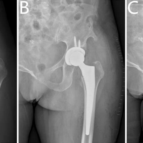 A Preoperative Radiograph Of The Hip Of A Year Old Male With