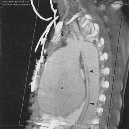 Marfan Syndrome Aortic Dissection