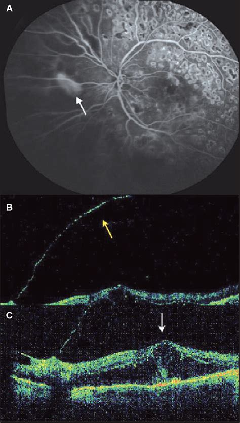 Figure 1 From Spontaneous Resolution Of Vitreomacular Traction