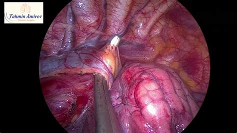 VATS Enucleation Of Esophageal Leiomyoma YouTube