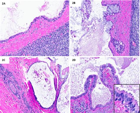 Case 1104 A Female In Her Early 50s With A Parotid Mass Department Of Pathology