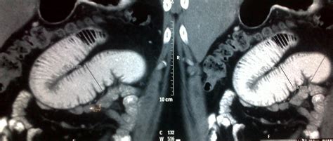 DR. KEYUR S. BHATT (MS, MRCSEd): CASE: Acute PV & SMV thrombosis ...