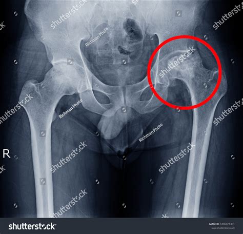 Image X-ray Hip Showing Left Femoral Stock Photo 1286871301 | Shutterstock