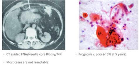 Pancreatic Pathology Flashcards Quizlet