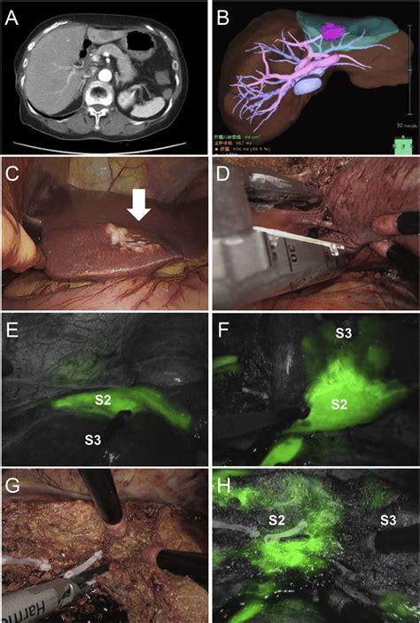 Laparoscopic Segment Segmentectomy Using Indocyanine Green Icg