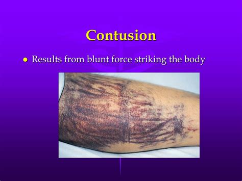 PPT - Soft-Tissue Injuries PowerPoint Presentation, free download - ID ...