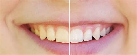 5 Benefits Of Whitening Teeth