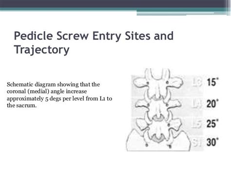 Technique Transpedincular Screw Placement