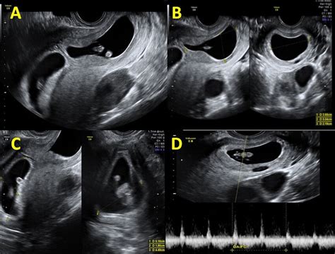 Heterotopic Pregnancy With Intrauterine Gestation And Cervical Ectopic