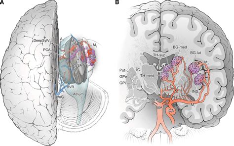 Deep Arteriovenous Malformations in the Basal Ganglia, Thalamus, and Insula: Microsurgical ...