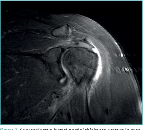 Pdf Supraspinatus Tendinopathy Diagnosis By Ultrasound And Magnetic