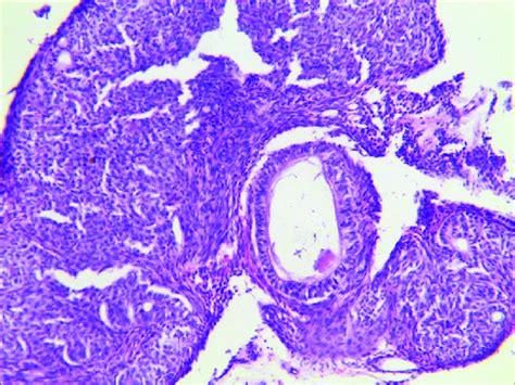 Microscopically Tumor Composed Of Epithelial Cells Proliferating In