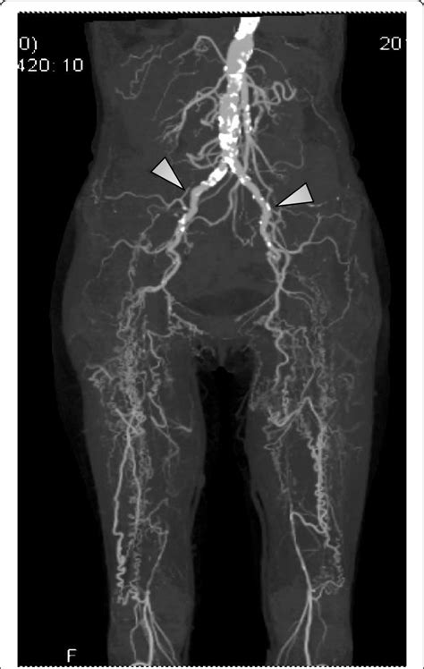 Takayasu Arteritis Involving Aorta With Skipped Segments Magnetic