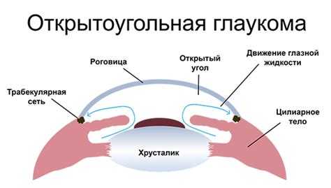 Open-angle glaucoma - treatment, causes, symptoms, degrees, surgery in Kyiv