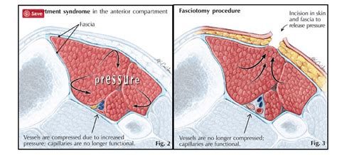 Compartment Syndrome Pathophysiology