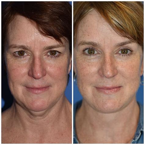 The Seattle Blepharoplasty And Eyelid Center Puget Sound Robyneeimhin