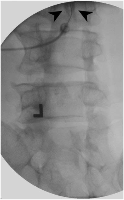 Anterior Posterior Fluoroscopic View Of The Attempted Myelogram Download Scientific Diagram