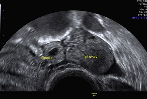 Ultrasound In Obstetrics And Gynaecology Obstetrics Gynaecology And Reproductive Medicine