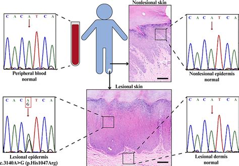 Jle European Journal Of Dermatology Unilateral Focal Palmoplantar