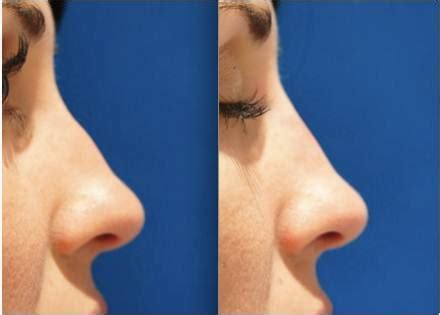 Nose Filler Non Surgical Rhinoplasty At Our Expert Sydney Clinic