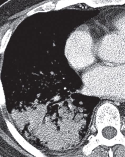 Radiologic Implications Of The 2011 Classification Of Adenocarcinoma Of