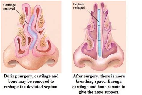 What To Expect After Septoplasty And Sinus Surgery Westside Sinus