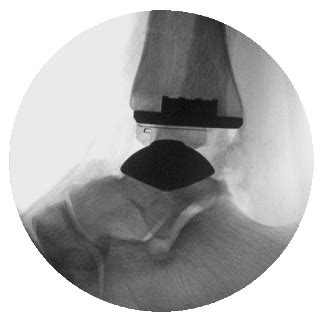 ankle replacement surgery - Advanced Foot And Ankle Center Of San Diego