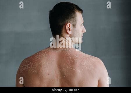 Dermatology And Skin Conditions Blister On Skin Of An Asian Woman Due