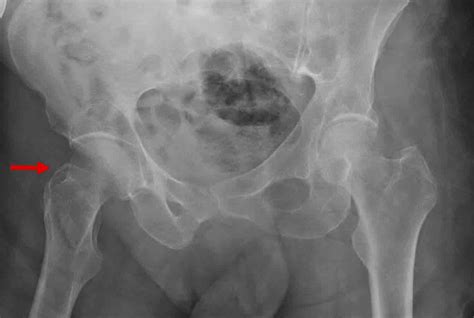 Timing Of Hip Fracture Surgery The Hospital Medical Director