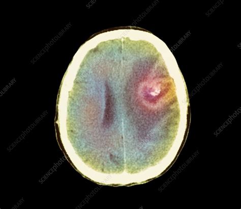 Astrocytoma Brain Cancer Ct Scan Stock Image M134 0496 Science